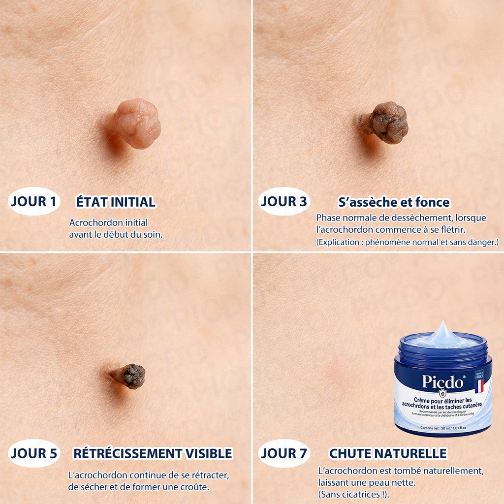 𝐏𝐢𝐜𝐝𝐨®𝐂𝐫è𝐦𝐞 𝐄𝐟𝐟𝐚𝐜𝐞𝐮𝐫 𝐝’𝐀𝐜𝐫𝐨𝐜𝐡𝐨𝐫𝐝𝐨𝐧𝐬 & 𝐝𝐞 𝐓𝐚𝐜𝐡𝐞𝐬 – 𝟕 𝐉𝐨𝐮𝐫𝐬 (𝐅𝐨𝐫𝐦𝐮𝐥𝐞 𝐙é𝐫𝐨 𝐃𝐨𝐮𝐥𝐞𝐮𝐫, 𝐙é𝐫𝐨 𝐂𝐢𝐜𝐚𝐭𝐫𝐢𝐜𝐞) 🌹
