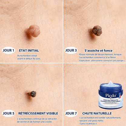 𝐏𝐢𝐜𝐝𝐨®𝐂𝐫è𝐦𝐞 𝐄𝐟𝐟𝐚𝐜𝐞𝐮𝐫 𝐝’𝐀𝐜𝐫𝐨𝐜𝐡𝐨𝐫𝐝𝐨𝐧𝐬 & 𝐝𝐞 𝐓𝐚𝐜𝐡𝐞𝐬 – 𝟕 𝐉𝐨𝐮𝐫𝐬 (𝐅𝐨𝐫𝐦𝐮𝐥𝐞 𝐙é𝐫𝐨 𝐃𝐨𝐮𝐥𝐞𝐮𝐫, 𝐙é𝐫𝐨 𝐂𝐢𝐜𝐚𝐭𝐫𝐢𝐜𝐞) 🌹