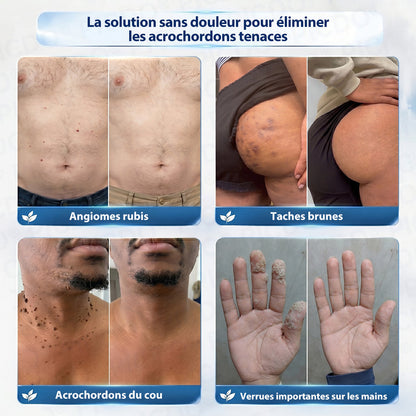 𝐏𝐢𝐜𝐝𝐨®𝐂𝐫è𝐦𝐞 𝐄𝐟𝐟𝐚𝐜𝐞𝐮𝐫 𝐝’𝐀𝐜𝐫𝐨𝐜𝐡𝐨𝐫𝐝𝐨𝐧𝐬 & 𝐝𝐞 𝐓𝐚𝐜𝐡𝐞𝐬 – 𝟕 𝐉𝐨𝐮𝐫𝐬 (𝐅𝐨𝐫𝐦𝐮𝐥𝐞 𝐙é𝐫𝐨 𝐃𝐨𝐮𝐥𝐞𝐮𝐫, 𝐙é𝐫𝐨 𝐂𝐢𝐜𝐚𝐭𝐫𝐢𝐜𝐞) 🌹