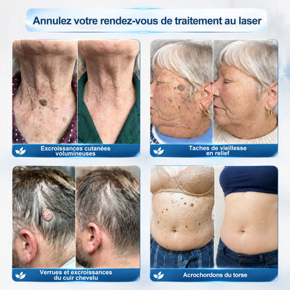 Boutique officielle de la marque |✅🎉𝐏i𝐜𝐝o® 7 Jours Effaceur de taches et d’excroissances cutanées(Zéro douleur, zéro cicatrice – Roller) ⏳