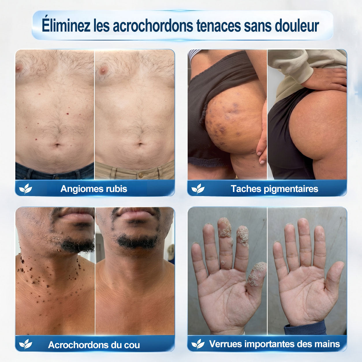 Boutique officielle de la marque |✅🎉𝐏i𝐜𝐝o® 7 Jours Effaceur de taches et d’excroissances cutanées(Zéro douleur, zéro cicatrice – Roller) ⏳