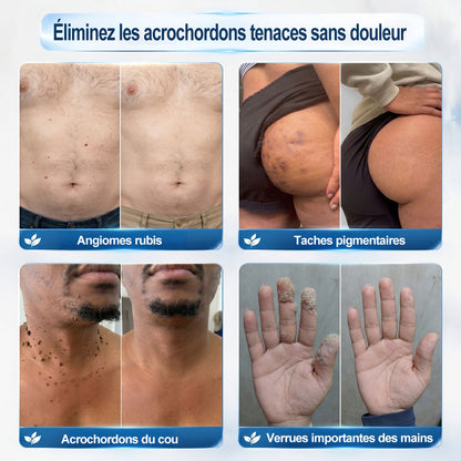 Boutique officielle de la marque |✅🎉𝐏i𝐜𝐝o® 7 Jours Effaceur de taches et d’excroissances cutanées(Zéro douleur, zéro cicatrice – Roller) ⏳